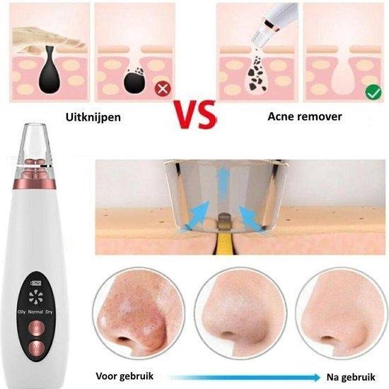 BlackHead Remover uitleg functie